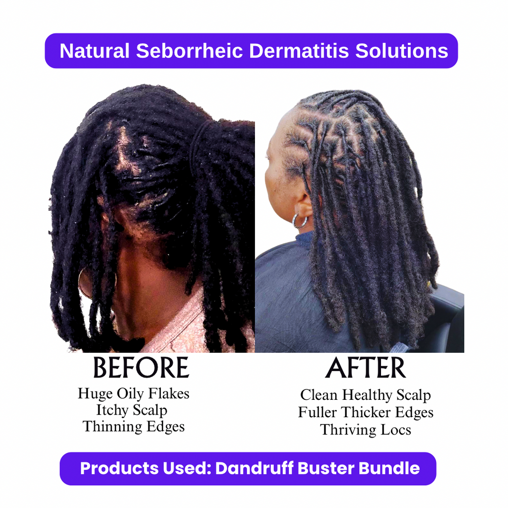Dandruff Buster Bundle