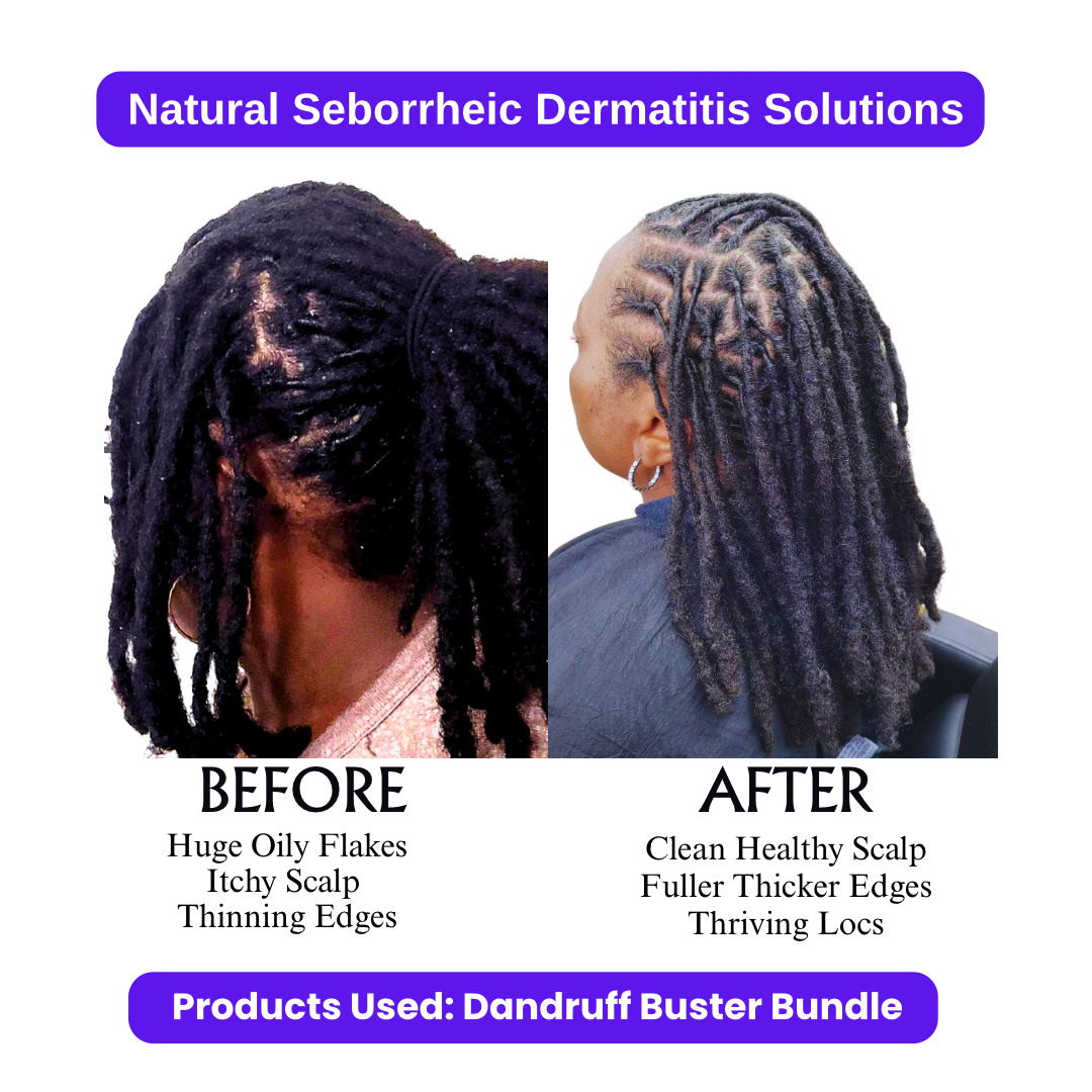 Dandruff Buster Bundle